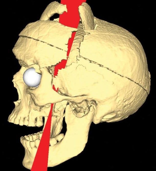 The Frontal Lobe of Phineas Gage Past Medical History
