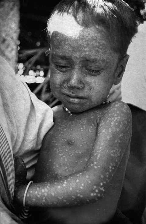 Rahima Banu, the last known natural case of variola major, photographed in 1975